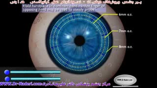 عمل کراتوپلاستی هدایتی-مرکز چشم پزشکی دکتر علیرضا نادری