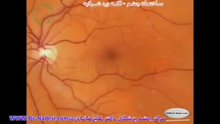لکه زرد شبکیه چشم یا ماکولا - مرکز چشم پزشکی دکتر علیرضا نادری