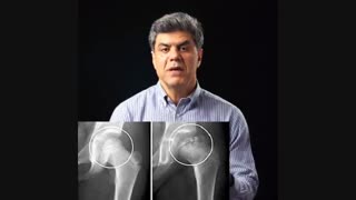 بیماری پرتس چیست