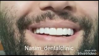 ونیر کامپوزیت-لمینت-دندانپزشکی نسیم قیطریه
