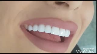 دندانپزشکی نسیم قیطریه-درمانگاه نسیم قیطریه-لمینت -–کامپوزیت-ونیر-ارتودنسی-ایمپلنت-کاشت دندان