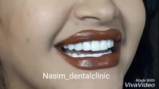 دندانپزشکی نسیم قیطریه-درمانگاه نسیم قیطریه-لمینت –-کامپوزیت-ونیر-ارتودنسی-ایمپلنت-کاشت دندان