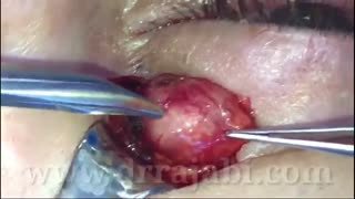 جراحی تومور شوانوم کاسه چشم