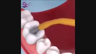 ترمیم کامپوزیت