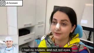 نه کبودی و نه قرمزی چشم. هفت روز بعد از عمل بینی عالی شد.