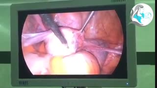 عمل لاپاراسکوپی کوتر تخمدان در بیمار PCO