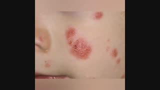 بیماری پوستی پسوریازیس