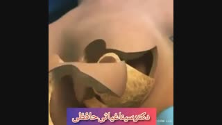 لیفت سینه