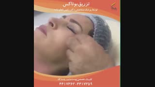 آموزش بوتاکس کنار چشم