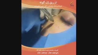 برجسته سازی گونه با تزریق ژل