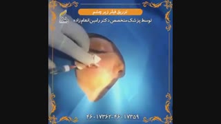 فیلم تزریق ژل زیر چشم