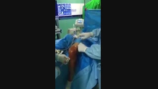 عمل بازسازی رباط صلیبی قدامی با الوگرافت