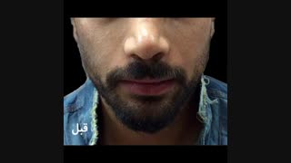 زاویه سازی صورت در مردان