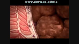 بواسیر یا هموروئید چیست؟ - درمان کلینیک