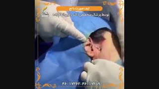 فیلم لیفت صورت با نخ