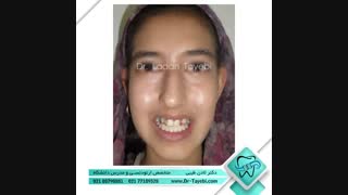 درمان تنگی فک بالا | دکتر طیبی