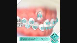 دندان نیش نهفته | دکتر لادن طیبی