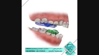 دستگاه فانکشنال ارتودنسی | دکتر لادن طیبی