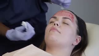 آموزش استفاده از میکرونیدلینگ