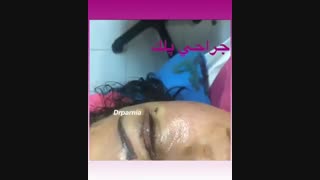جراحی پلک توسط دکتر رفیع پرنیا ترمیم دندان