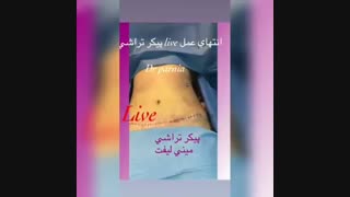 فیلم پیکر تراشی مزوتراپی