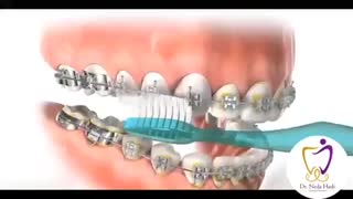 نحوه مسواک زدن دندان های ارتودنسی شده