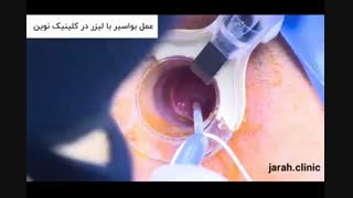 فیلم عمل بواسیر  یا هموروئید در کلینیک نوین