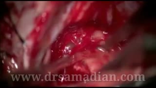 تومور عصب تعادلی-شنوایی(CPA)