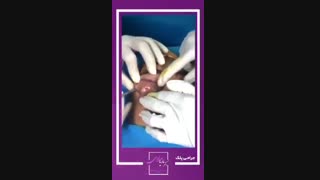 جراحی بلفاروپلاستی
