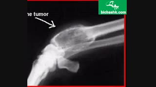 درباره سرطان استخوان چه می دانید؟ - مجله پزشکی بیچشک