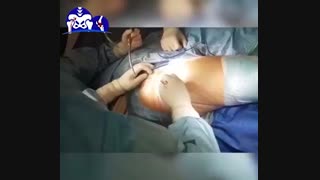 جراحی تعویض مفصل لگن در جوانان