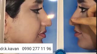 جراحی زیبایی بینی استخوانی و گوشتی توسط دکتر کاوان