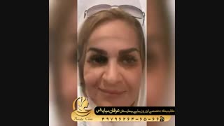 بهترین روش کاشت ابرو