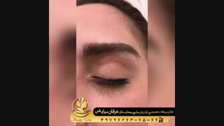 کاشت ابرو در تهران