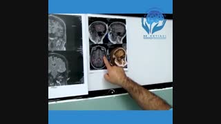 فیلم جراحی تشنج