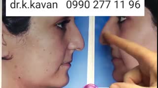 عمل بینی با انحراف زیاد و نوک کاملا گوشتی