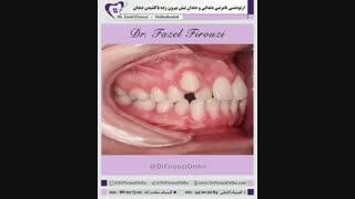 اکستراکشن دندانی | دکتر فیروزی