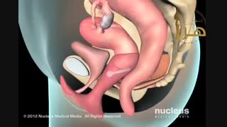 درمان بی اختیاری ادرار