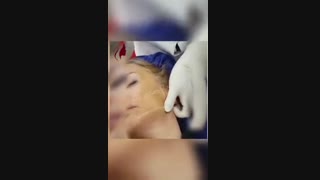 فیلم لیفت صورت با نخ توسط دکتر چعباوی زاده زیبایی پوست