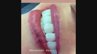 ابتسامة هولیود فی ایران مع افضل الاطباء و احسن الاسعار