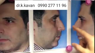 جراحی زیبایی بینی توسط دکتر کاوان