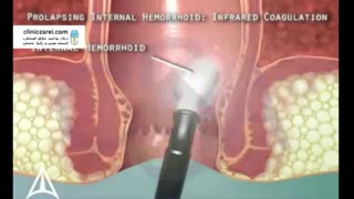 بررسی علائم بیماری بواسیر یا هموروئید خارجی و داخلی در کلینیک زارعی