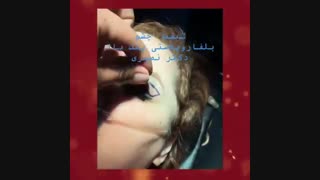 فیلم جراحی پلک بالا دکتر احمدرضا نصیری جراحی بینی