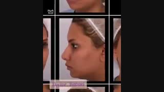 نمونه جراحی بینی دکتر کامران بابایی تزریق بوتاکس