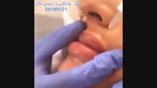 تزریق فیلر لب دکتر الهام کاکاوند 88199121