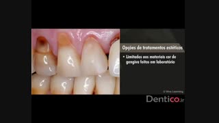 کامپوزیت VOCO - Amaris Gingiva