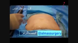 فیلم جراحی لیپوماتیک ,قیمت عمل پیکرتراشی 09122167875