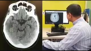 IMRT در رادیوتراپی مجدد مغز