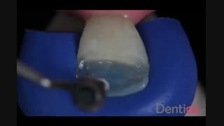 کامپوزیت IVOCLAR VIVADENT - IPS Empress Direct