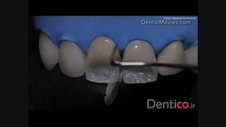 کامپوزیت GC G- aenial Anterior